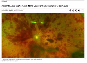 Dangers of Stem Cells for Eye Disease!