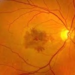 Danger of Retinal Atrophy with VEGF injections
