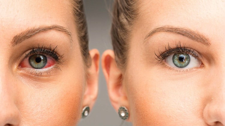 Degenerative Eye Disease: 7 Successful Natural Treatments