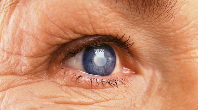 FEATURE | 7 Different Types Of Cataracts