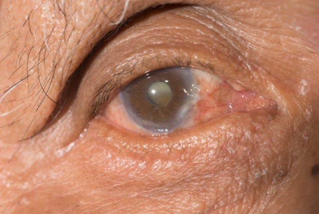 Progression | Cataract Treatment Without Surgery | Know Your Options