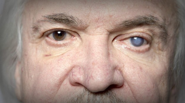 What Causes Cataracts? | Cataract Awareness Month | Everything You Need To Know