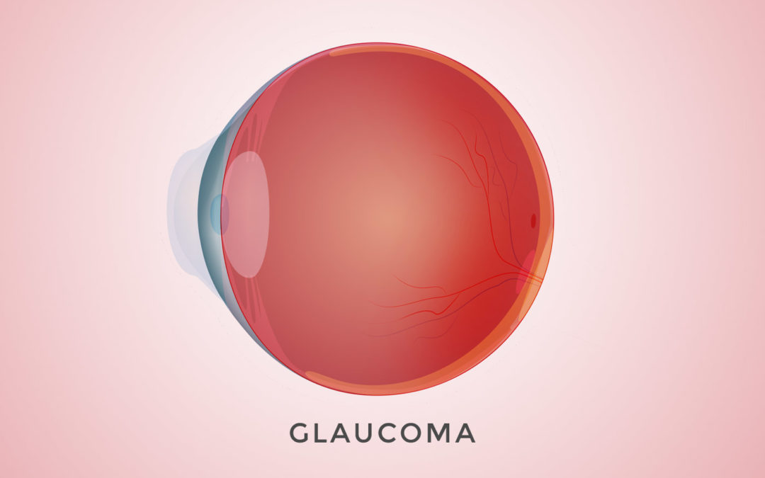 Common Risk Factors For Glaucoma