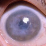 Fuchs Dystrophy and other Corneal Dystropies
