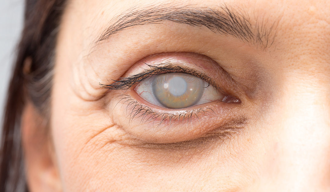 Cataracts causes in young age