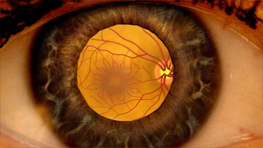 Dangerous Eye Condition Diabetic Macular Edema