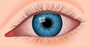 What Treatment Options Do I Have for Relieving Dry Eyes?