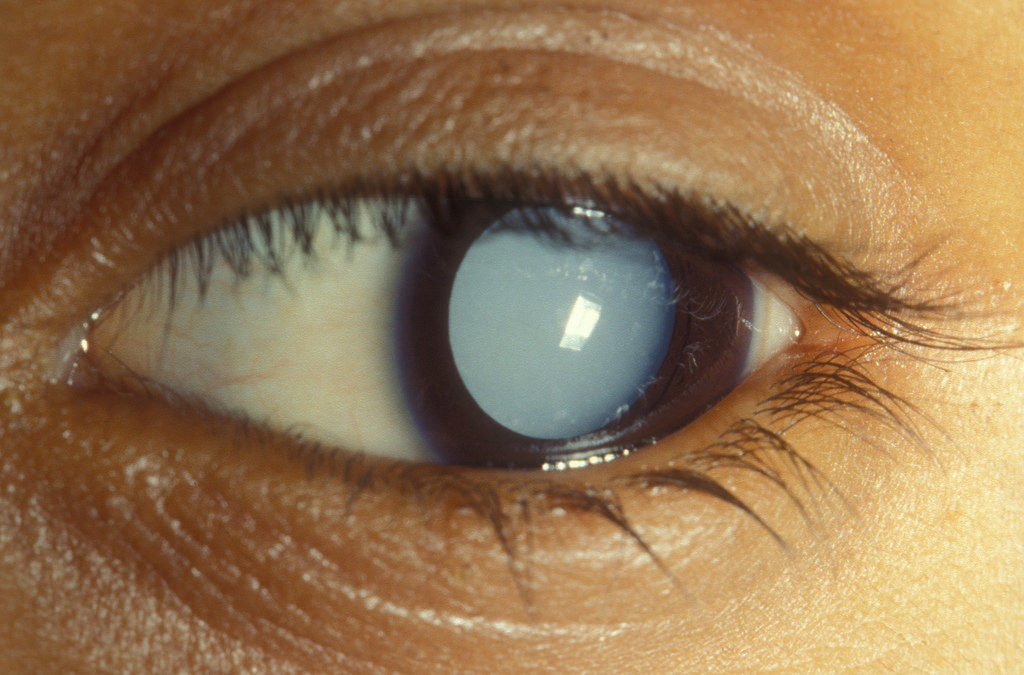 How is Cataract affecting our Lives & How to Prevent its Adverse Effects?