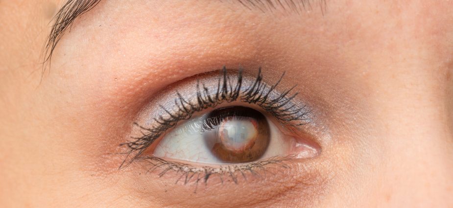 Dr. Kondrot Answers: Can Eye Drops Reverse Cataracts?