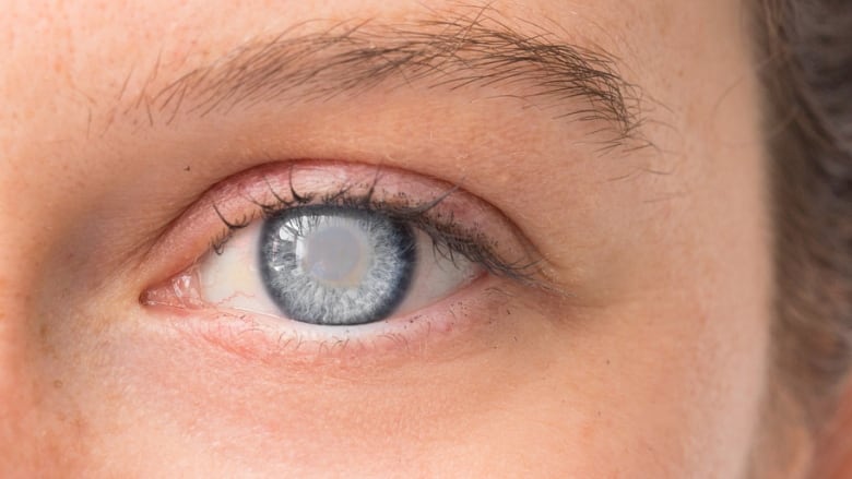 Dr. Kondrot Answers: How to Naturally Treat Cataracts?