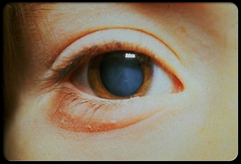 Eye-Drop is effective in reversing Cataracts