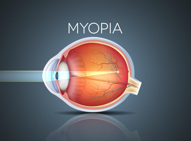 How can you effectively slow down Myopia?