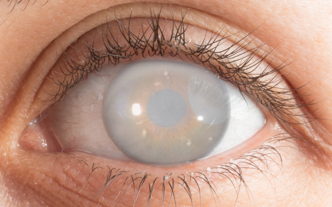 Cataracts treatment