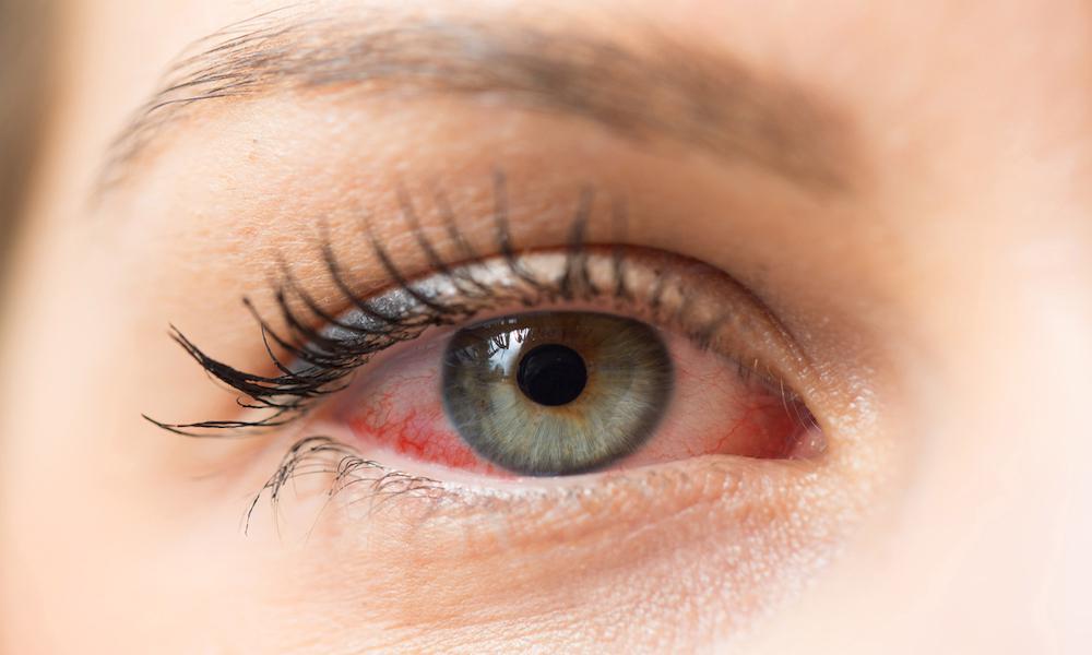 Precautionary Steps To Prevent Dry Eye Syndrome