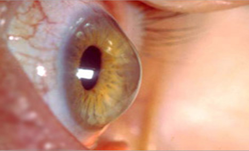 Keratoconus And How does it affects your Eyesight