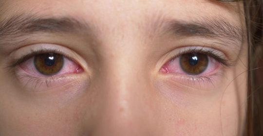 Ocular Allergies That Can Be Treated By Homeopathy