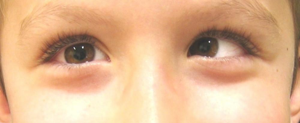Can Homeopathy Correct The Symptoms Of Lazy Eye Or Amblyopia?
