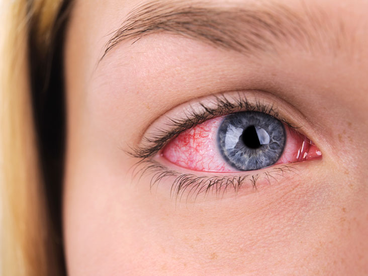 Red & Bloodshot Eyes: Common Causes and Remedies
